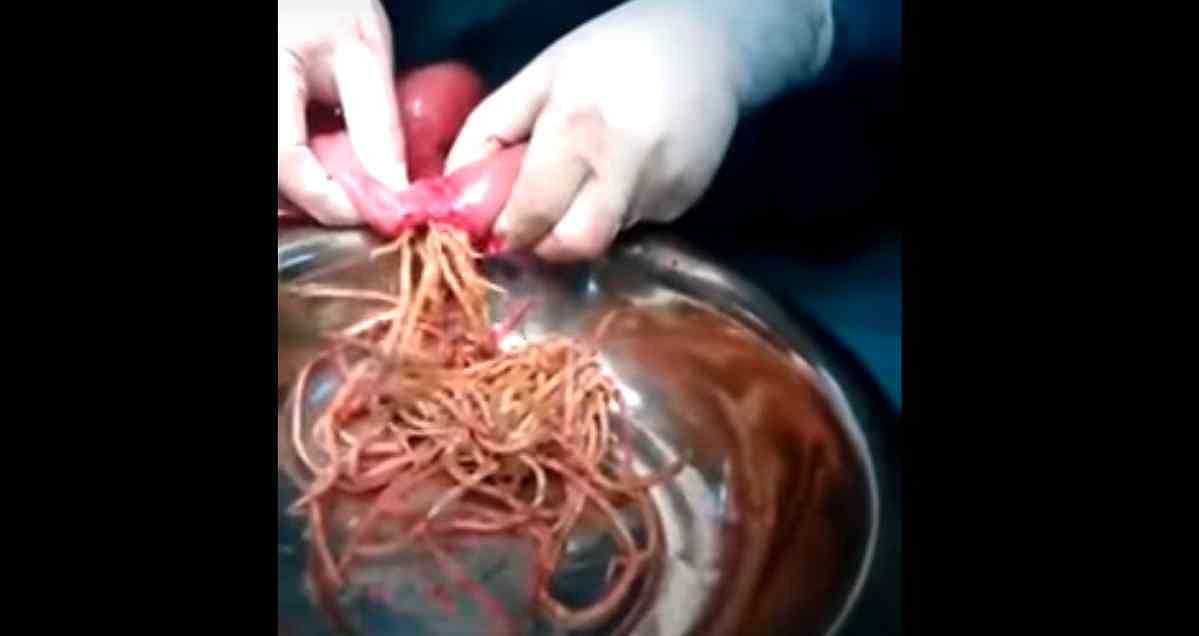 A WhatsApp video claims noodles are indigestible and they’ll have to be surgically removed if you eat them.