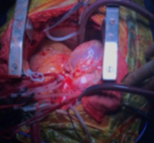 The procedure made way for the donor’s heart to be placed between the right lung & the original heart of the patient