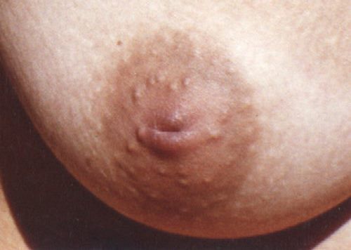 Inverted nipple deformity is an extremely common deformity affecting roughly every 1 in 30 women.