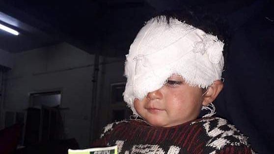 Eighteen-month-old Hiba Nisar is the youngest pellet victim in Kashmir.