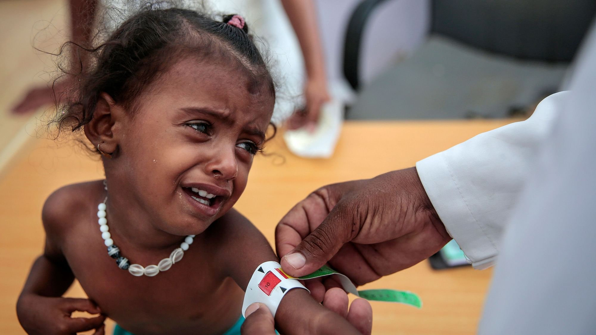 A doctor measures the arm of a malnourished girl at the Aslam Health Center, Hajjah in Yemen. &nbsp;