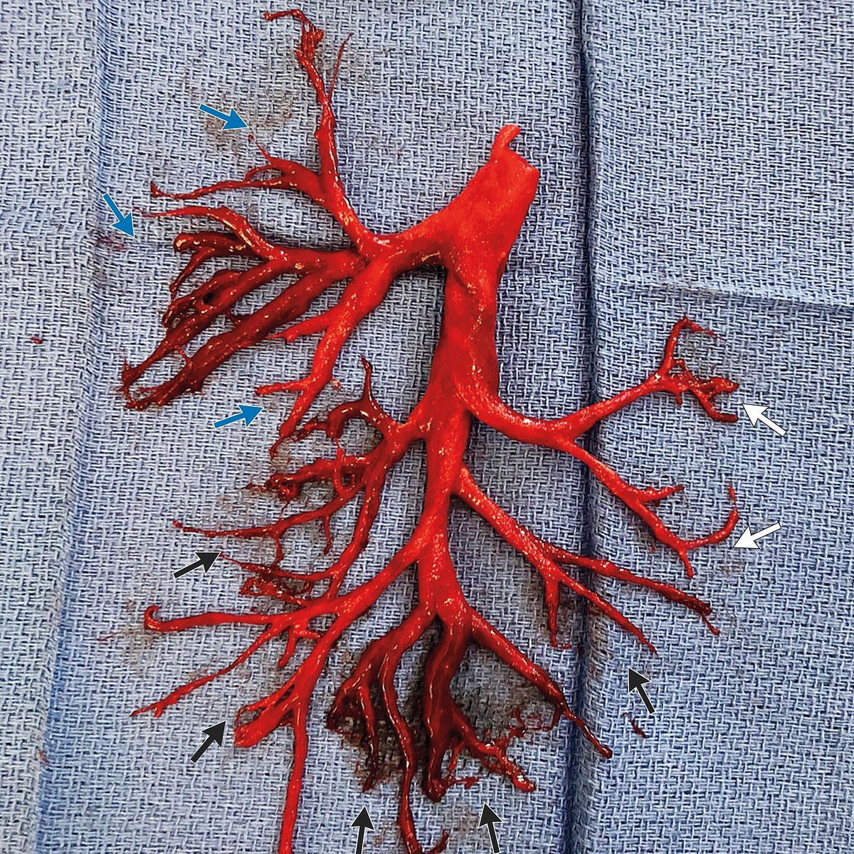 A 36-year-old man suffering from chronic heart disease failure, coughed up a part of his lung in a coughing fit.