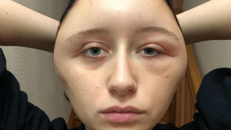 A 19-year-old’s head swelled to a massive size due to an allergic reaction from a hair dye. 