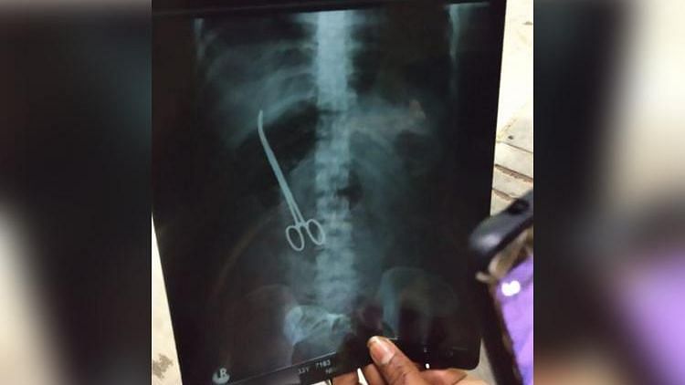 Hyderabad: A pair of surgical scissors have been found inside a woman, three months after she underwent surgery.