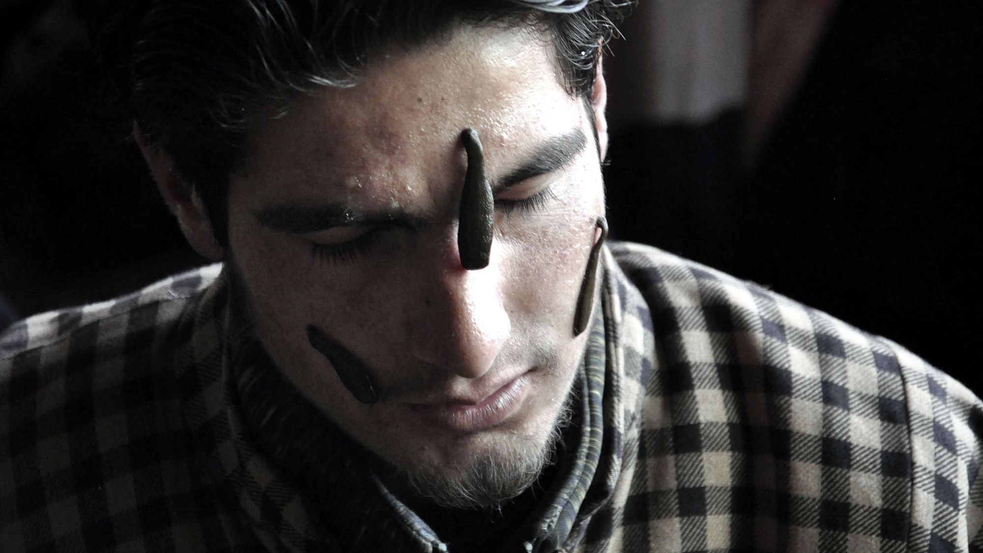 Image of a Kashmiri man undergoing ‘leech therapy’. Image used for representational purposes.