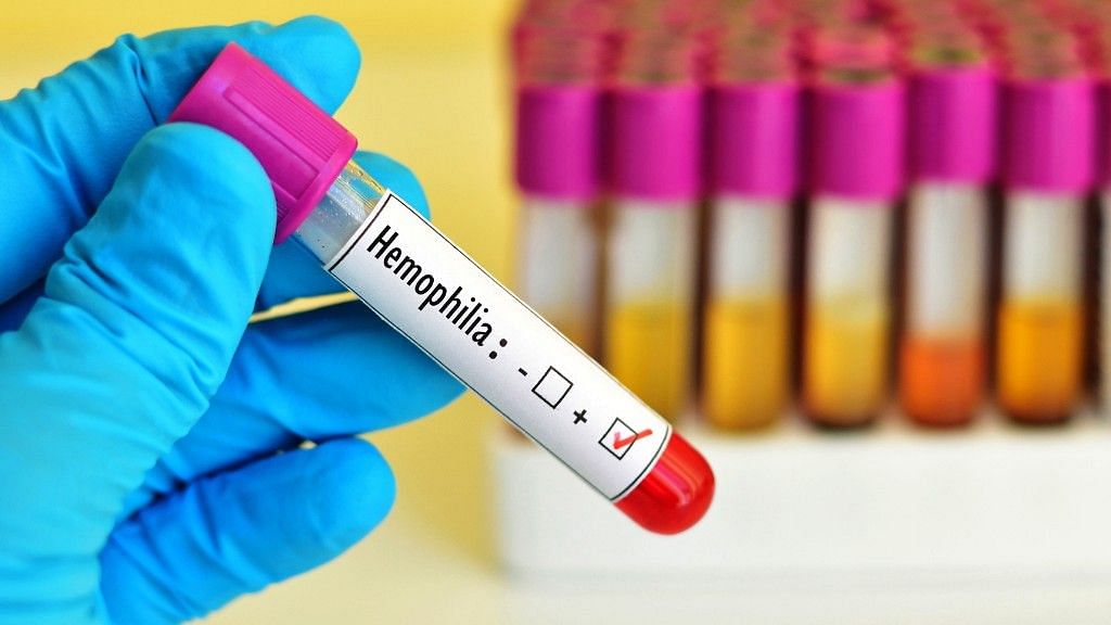 Health experts believe that nearly 80 percent of Indians with Haemophilia are undiagnosed due to lack of facilities.