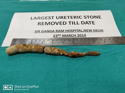 A team of doctors in Sir Ganga Ram Hospital have removed the "longest ureteric" stone from the ureter of a 35-year-old woman from Uttar Pradesh, in New Delhi on Tuesday. The stone was 22 cm long and weighed 60 grams, said a hospital statement, adding that its length was approximately the same as that of the ureter -- a urinary pipe leading from the kidney to the bladder. The normal length of the ureter is around 25 cm.