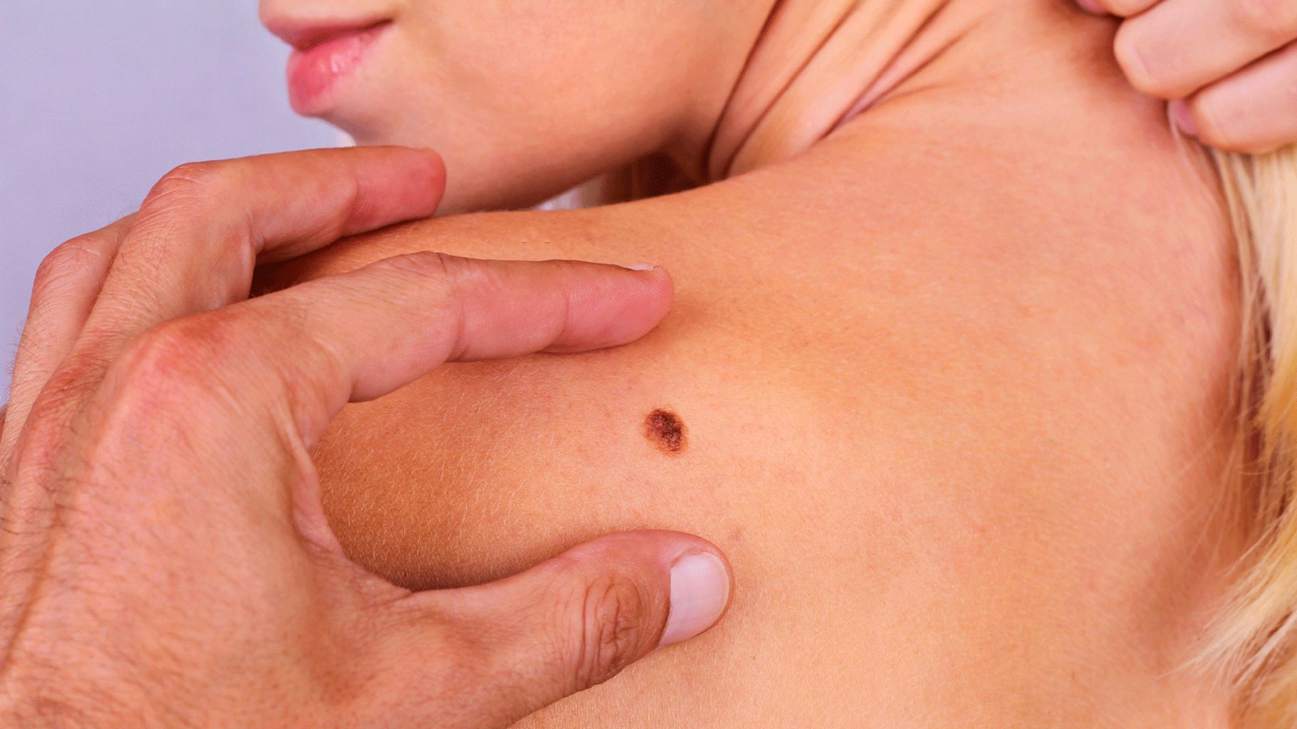 Of all the spots on our bodies, from acne to scars, birthmarks get the least attention. Are these always harmless? 