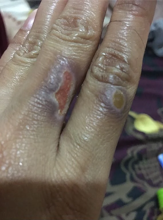 Sindhu Sharma shows the wounds she sustained after the family physically assaulted her.