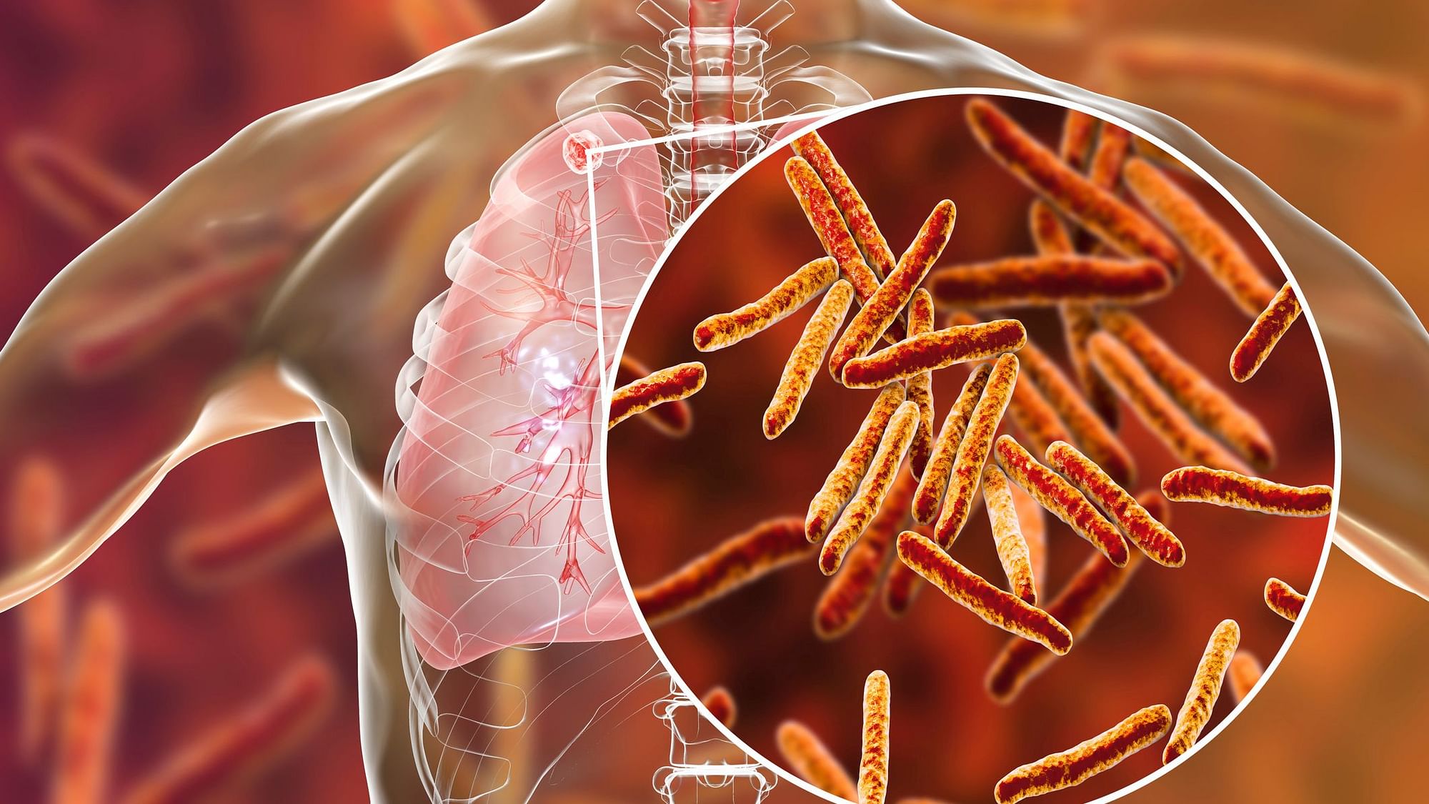 TB not a life-long infection in most people, finds a study.