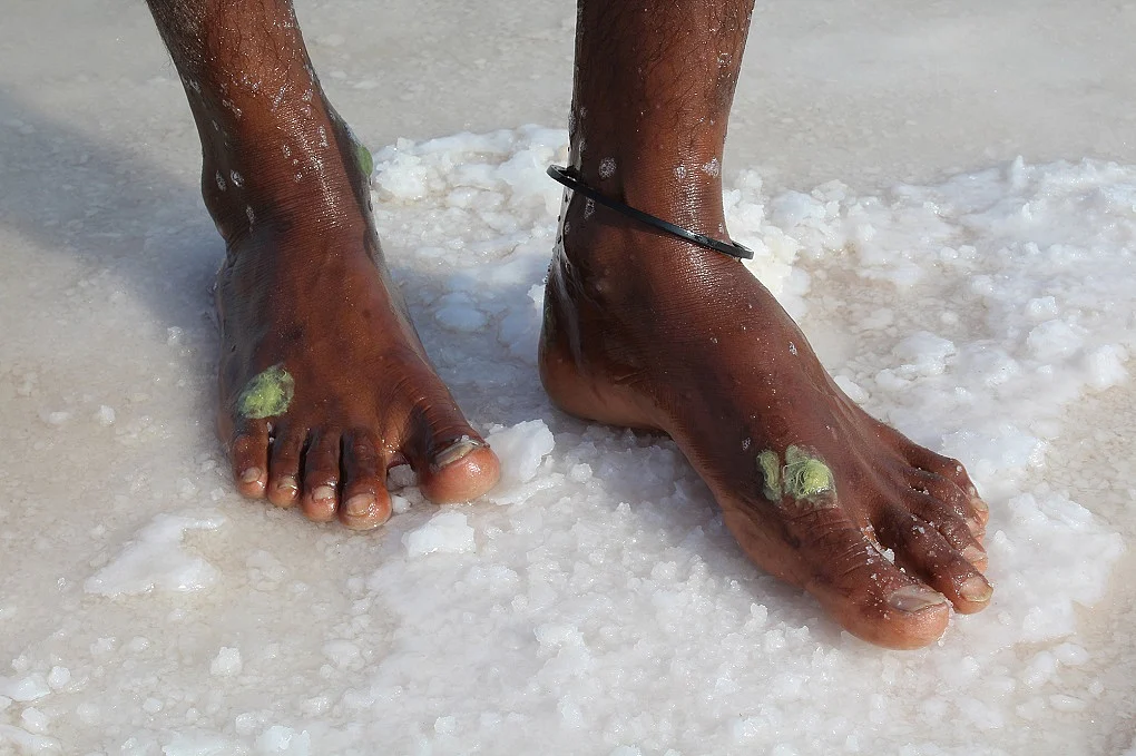 How the Salt Workers in Achro Thar Are Suffering Wounds Of Poverty