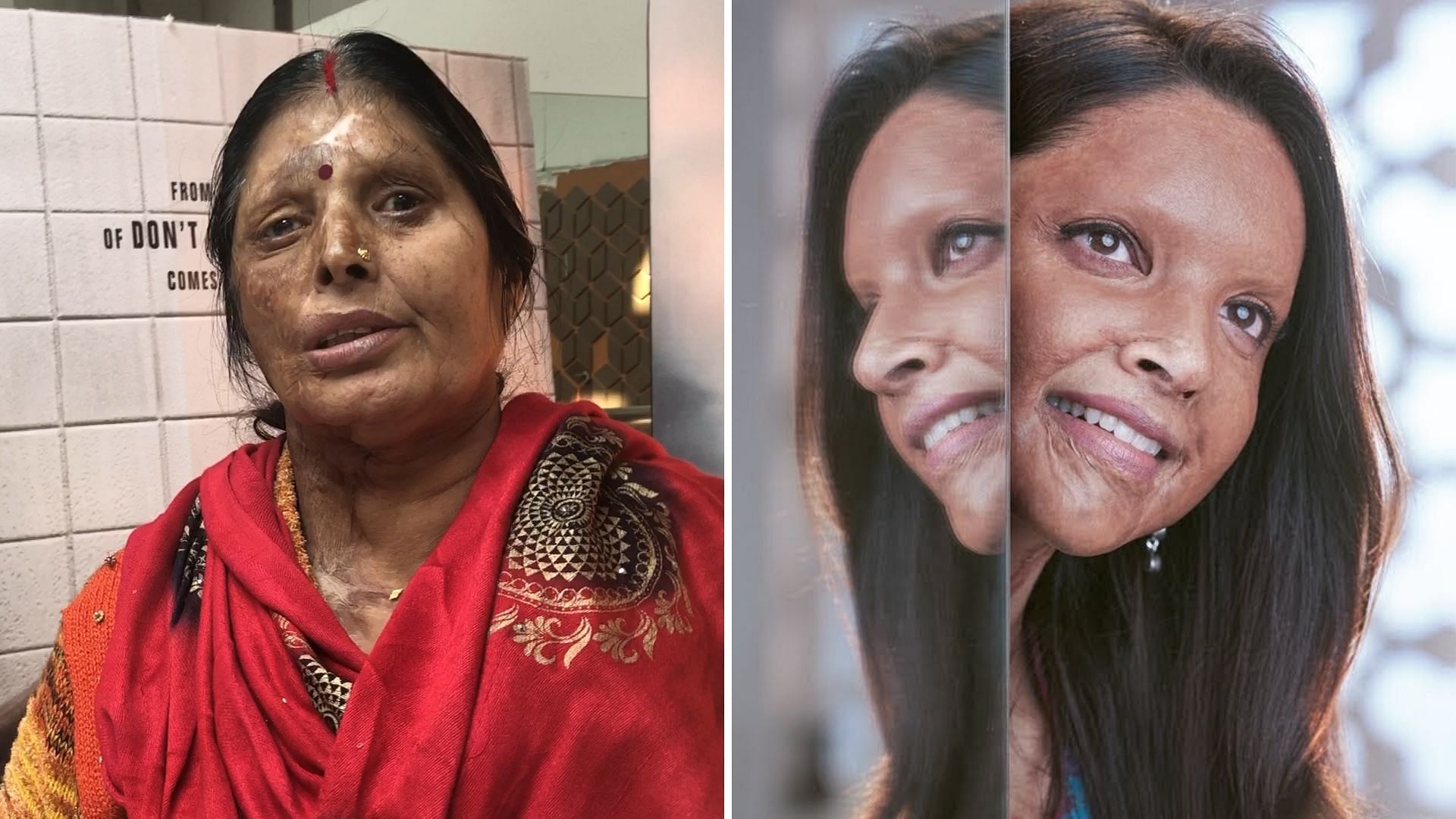An acid attack survivor watches Chhapaak.
