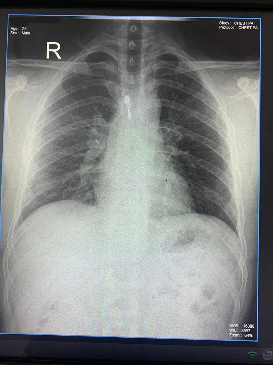 The doctors said that the white patches on my lungs showed the infection.