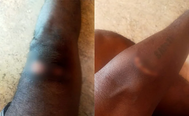 Injuries suffered by Martin