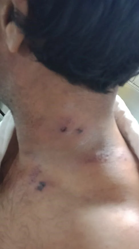 Skin infection of a crew member because of the poor quality of water onboard ship.