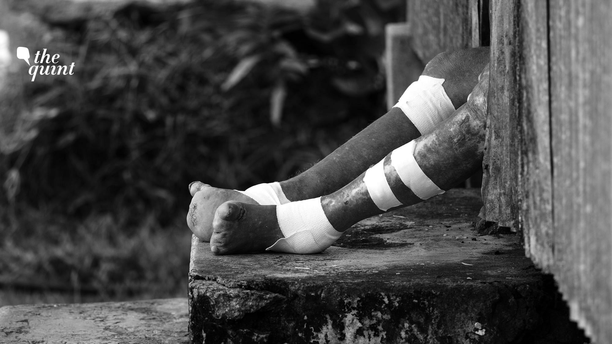 Image of a leprosy-affected person’s legs used for representational purposes.
