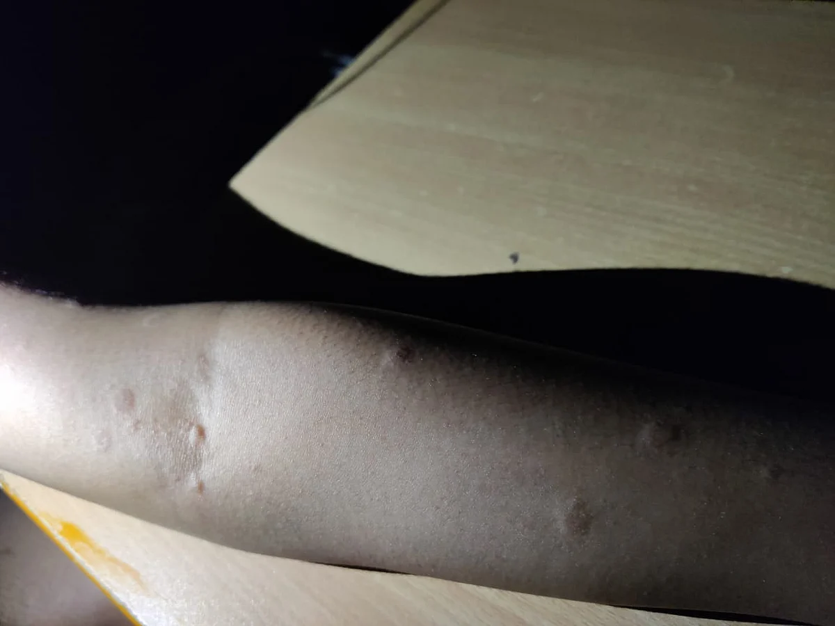 Rashes for 2 Weeks After Covishield Dose, No Follow Up From SII