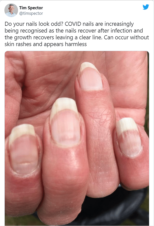 Following a COVID-19 infection, for a small number of patients the fingernails appear discoloured or misshapen. 