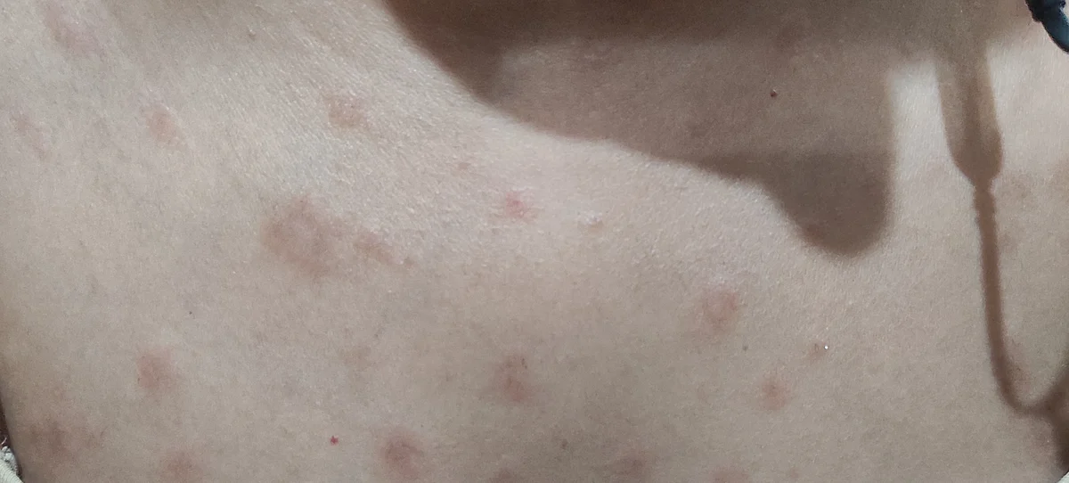 Rashes for 2 Weeks After Covishield Dose, No Follow Up From SII