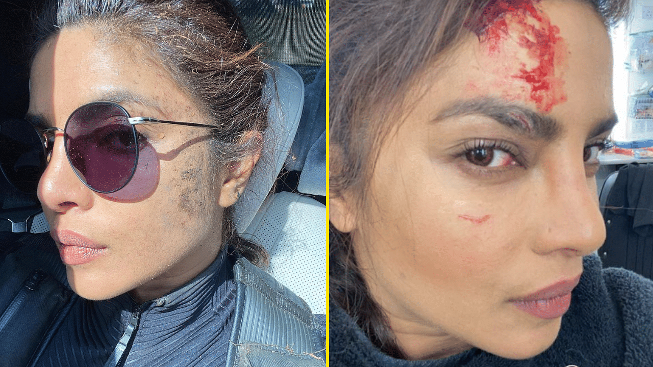 <div class="paragraphs"><p>Priyanka Chopra shares pictures of her injury on the sets of&nbsp;<em>Citadel.</em></p></div>
