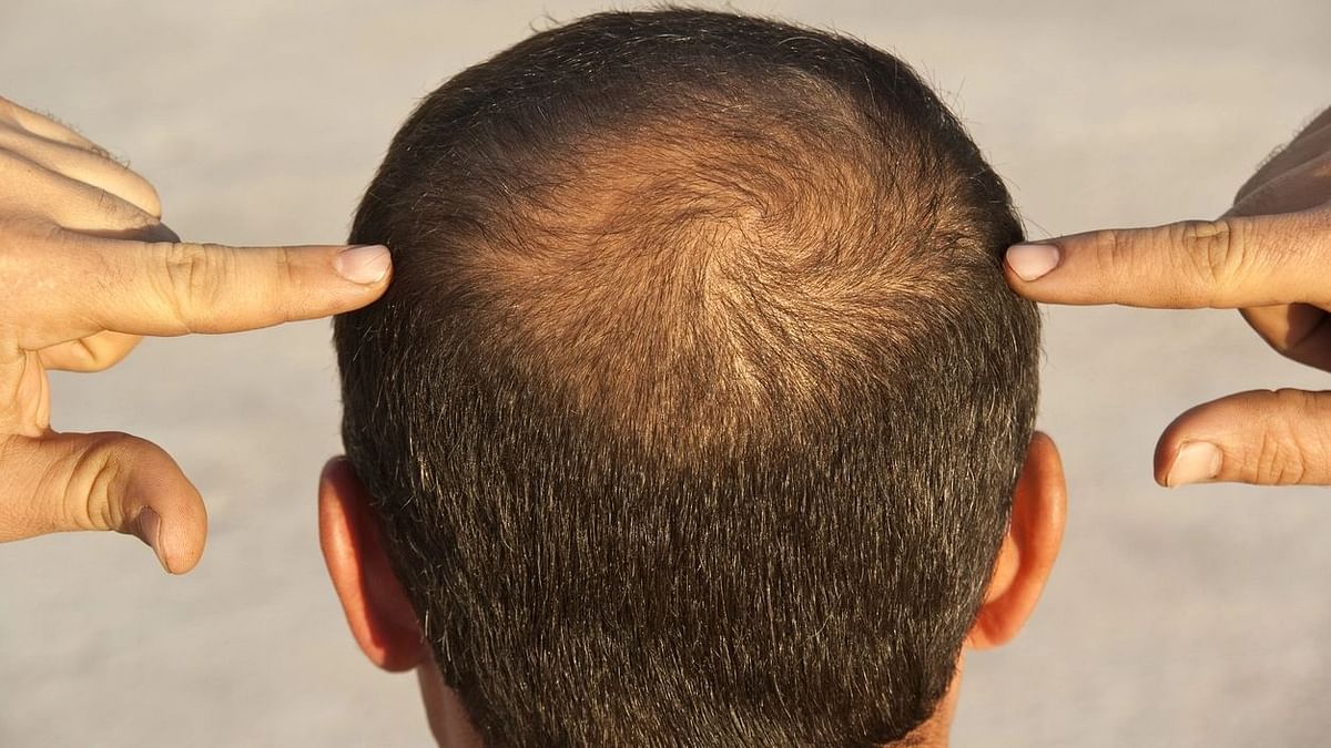 Men are genetically, hormonally, and behaviourally at a disadvantage when it comes to hair fall.