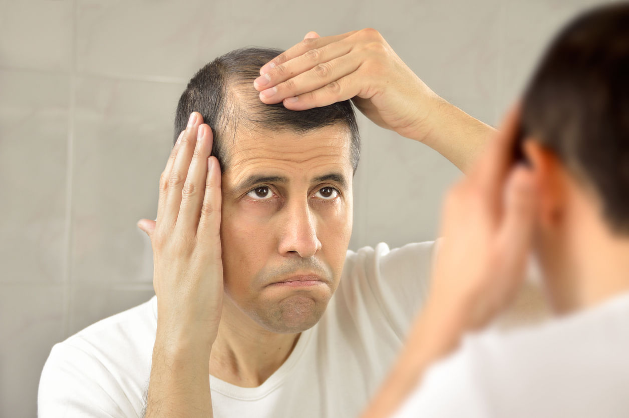 <div class="paragraphs"><p>Male baldness starts with a receding hairline: hair loss along the temple first and then finally on the crown of the head</p></div>