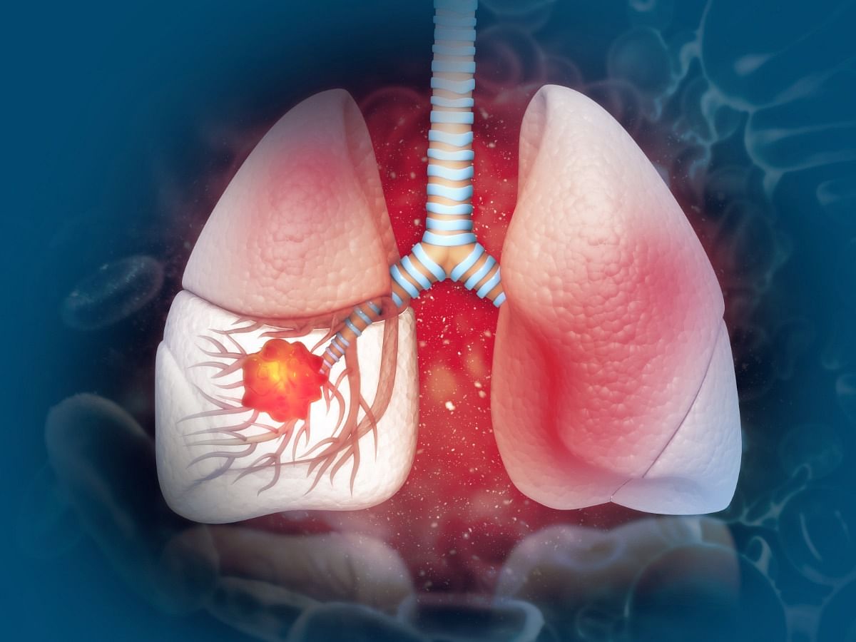 Lung Cancer: Types, Causes, Symptoms, Diagnosis Stages, and Treatment 
