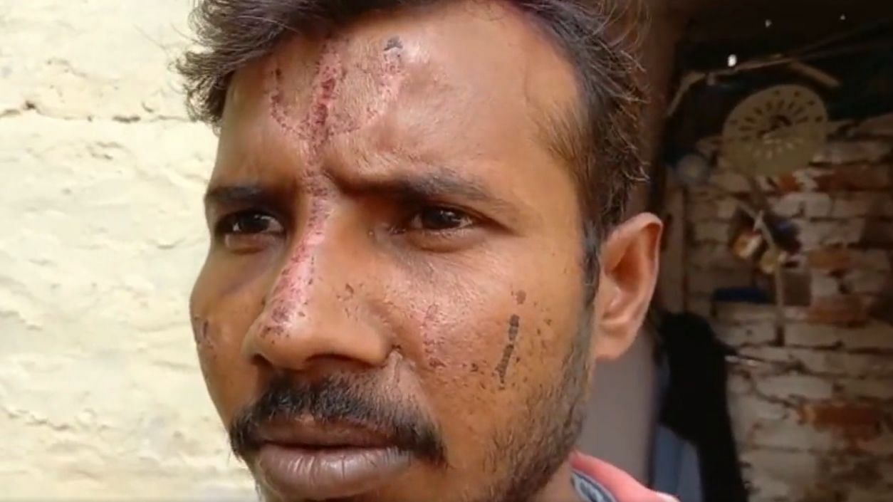 <div class="paragraphs"><p>A <em>trishul</em> (trident) was carved into the forehead of a man in Uttar Pradesh's Saharanpur.</p></div>