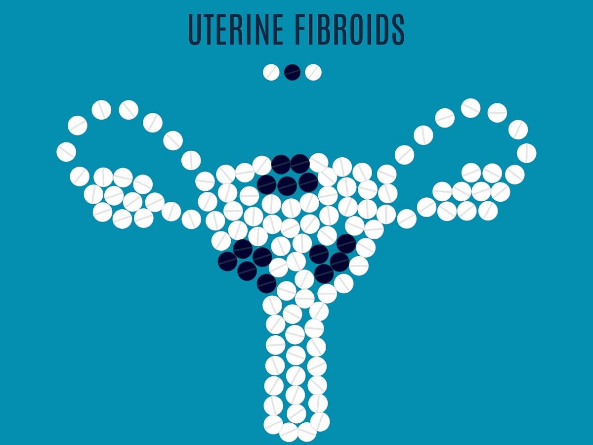 <div class="paragraphs"><p>Know about the condition of uterine fibroids in detail.</p></div>