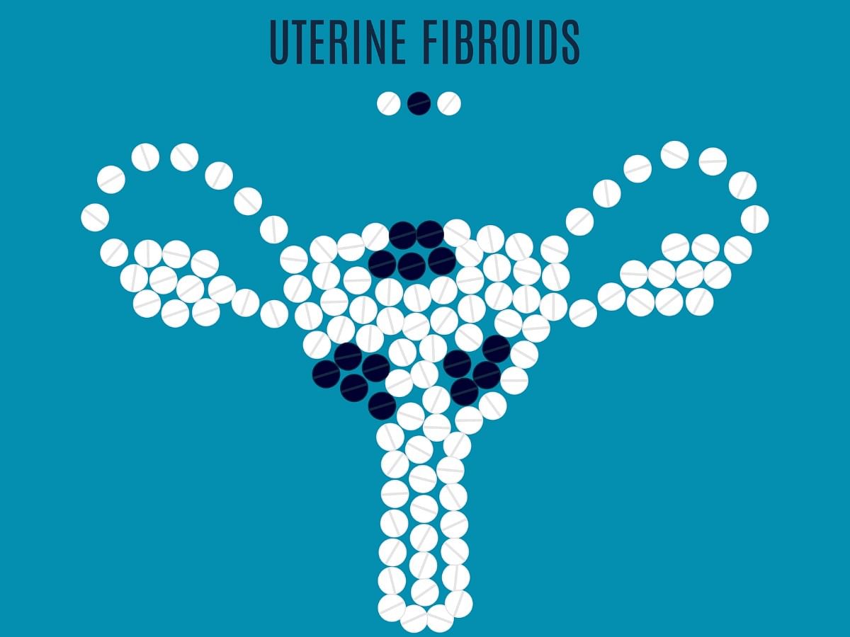 Uterine Fibroids: Symptoms, Types, Causes, Diagnosis and Treatment 