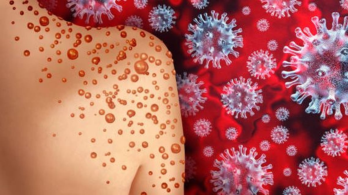 Monkeypox Variant: Delving Deeper Into the Disease - Vimarsana News