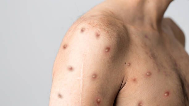 In a recent announcement, Britain has changed its monkeypox vaccine eligibility and rolled out a new program.