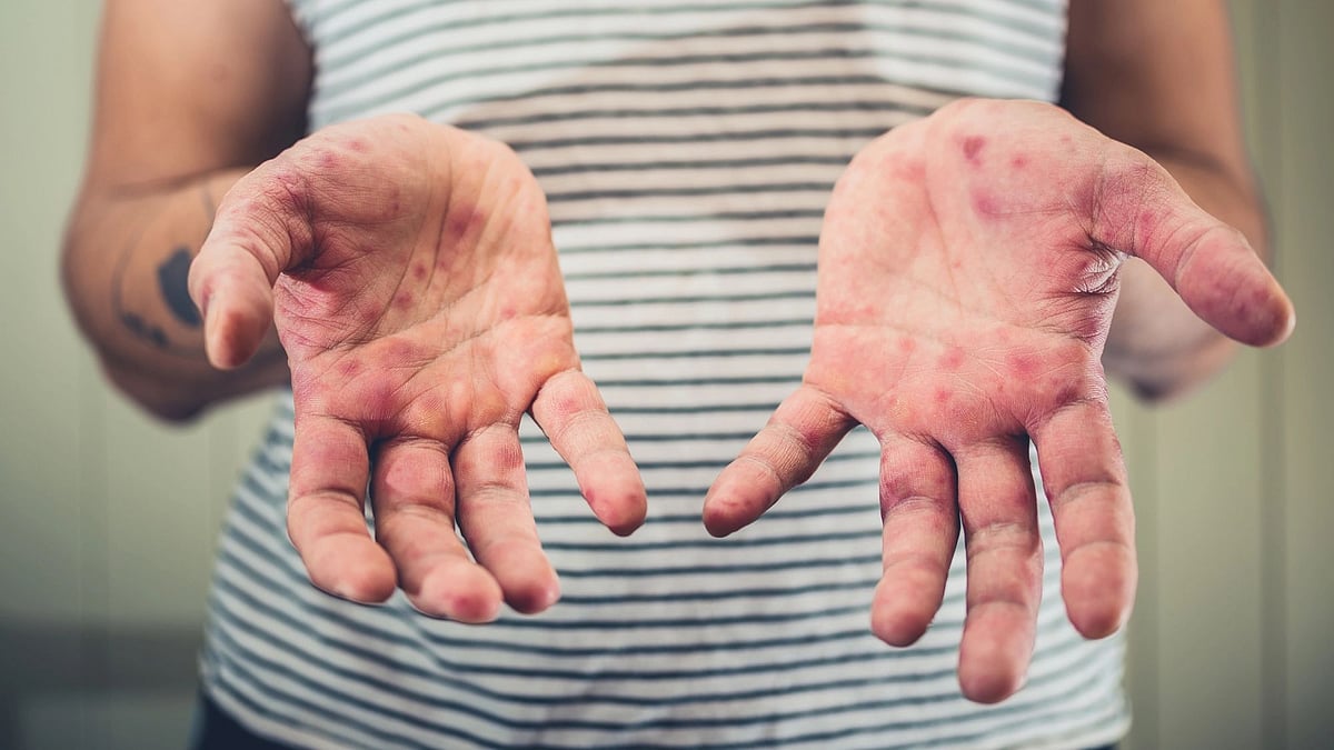 Hand Foot and Mouth Disease Cases Rise Above Warning Level in 27 Prefectures