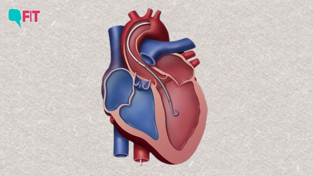 <div class="paragraphs"><p>The Impella device is revolutionising how <a href="https://www.thequint.com/fit/can-liver-problems-cause-abnormalities-in-your-heart-a-new-study-says-they-can">heart diseases</a> are treated.</p></div>