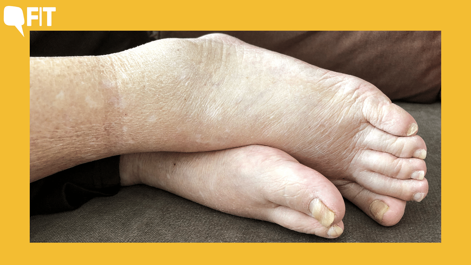 <div class="paragraphs"><p><a href="https://www.thequint.com/fit/heart-attack-women-signs-causes">Lymphatic Filariasis</a>, a neglected tropical disease (NTD), also known as elephantiasis, is a painful, disfiguring disease that is spread by mosquitoes.</p></div>