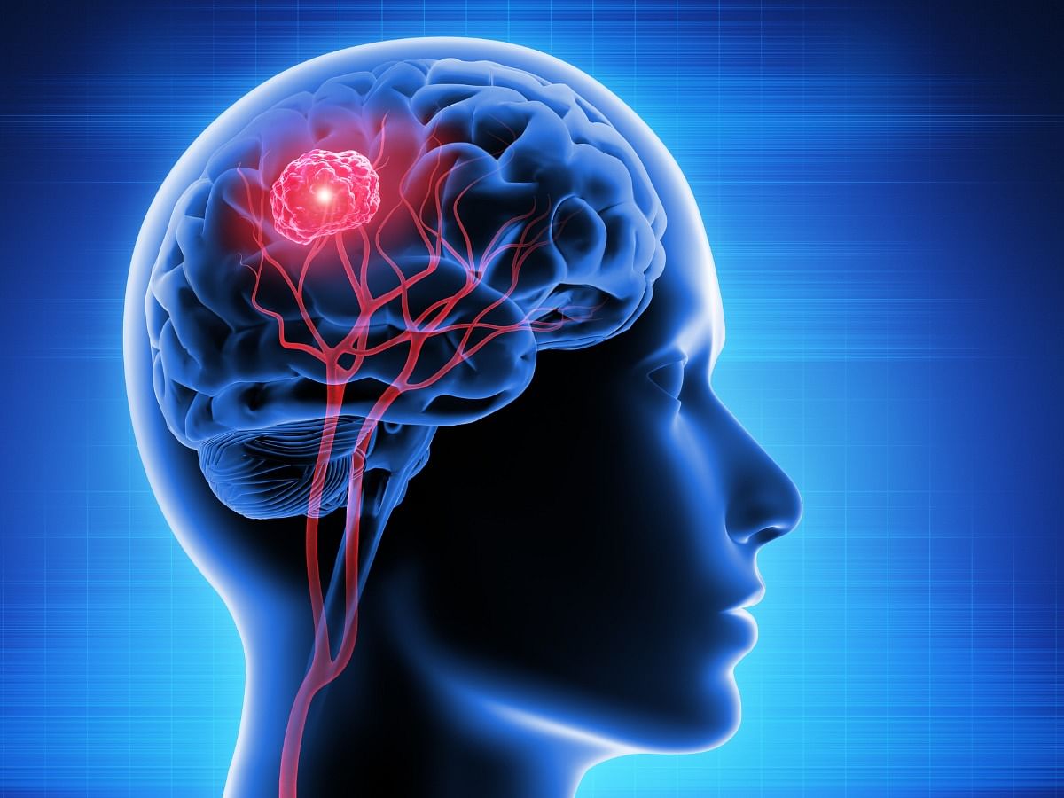 Brain Tumor: Symptoms, Causes, Diagnosis, & Treatment