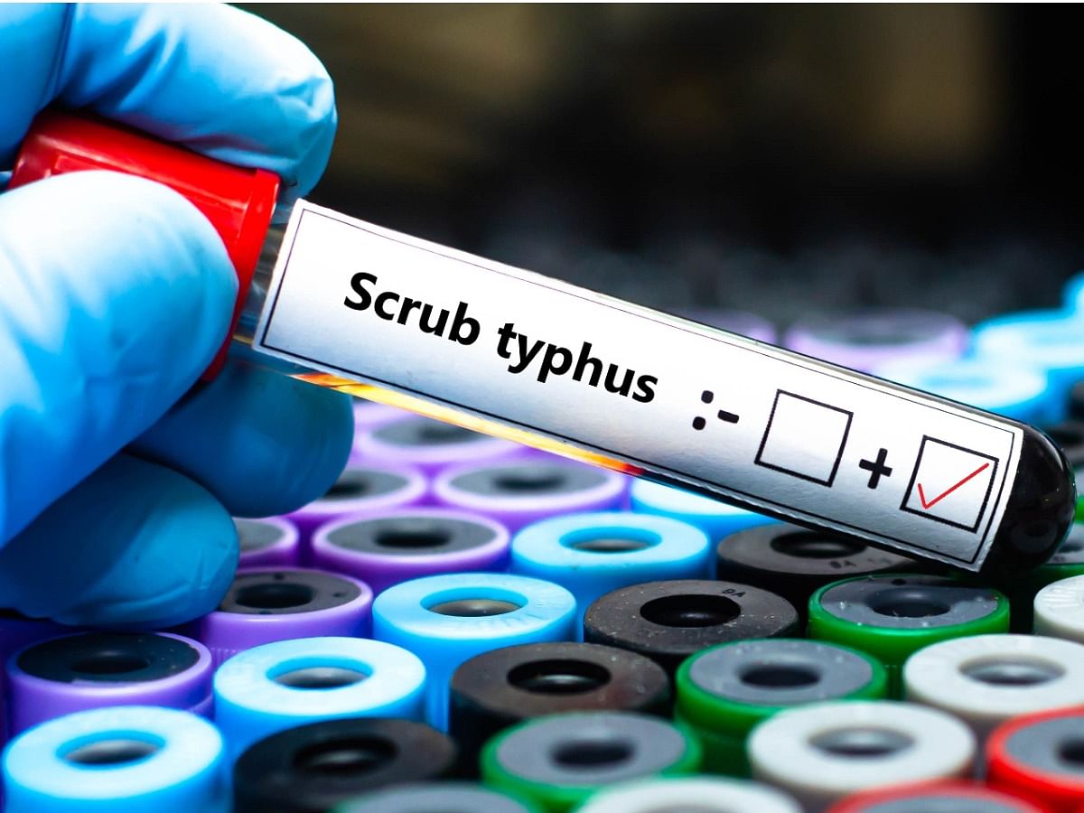 Scrub Typhus: 5 Deaths In Odisha & 9 In Shimla; Know More About the Infection