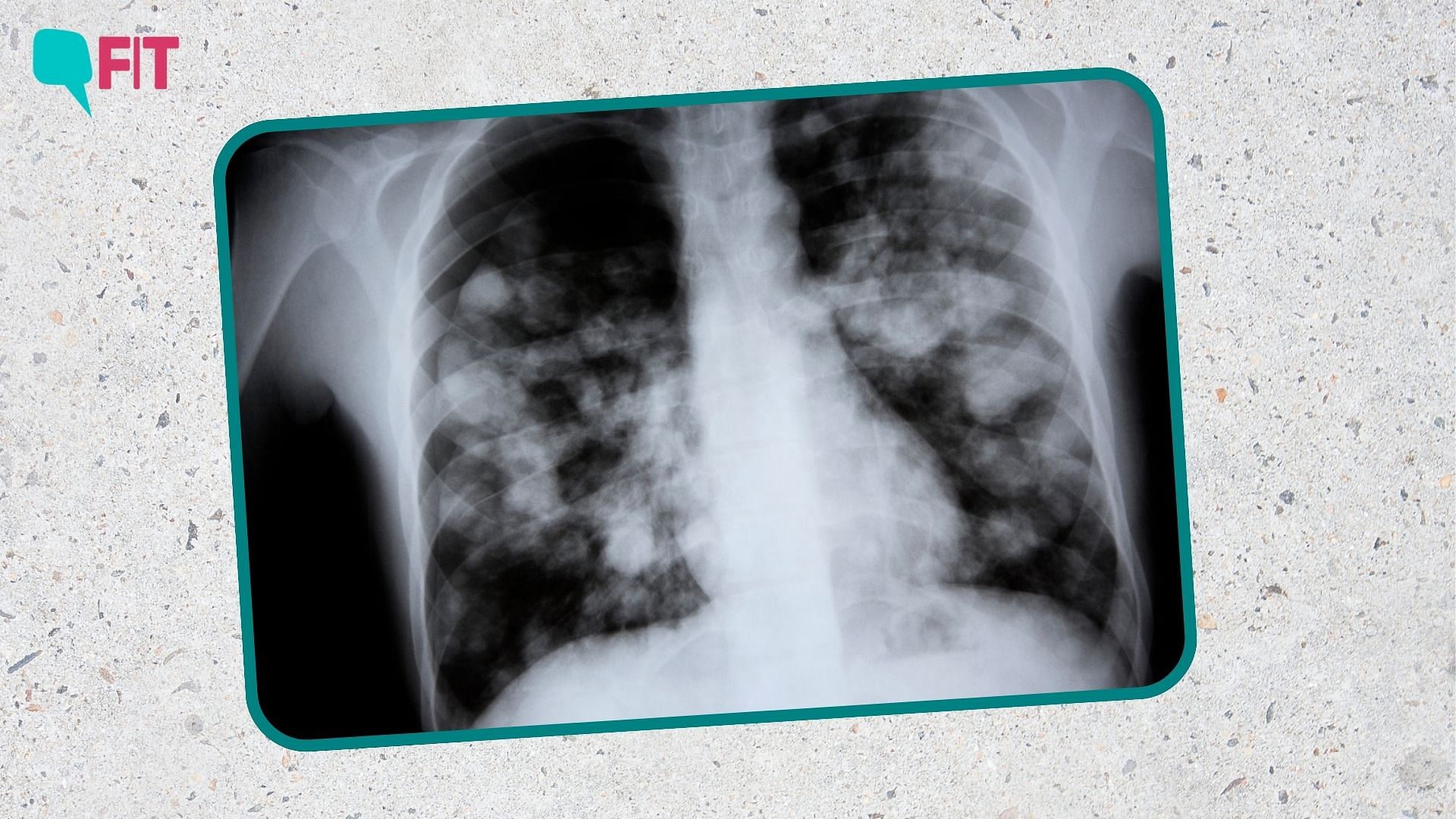 <div class="paragraphs"><p>White Lung PneumoniaL Symptoms, treatment (Image is for representational purpose only)</p></div>