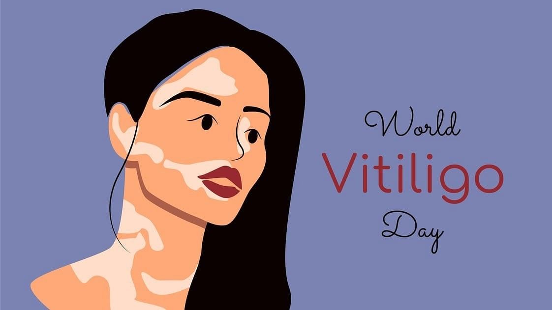 <div class="paragraphs"><p>World Vitiligo Day 2024: Know the history of the day and other details.</p></div>