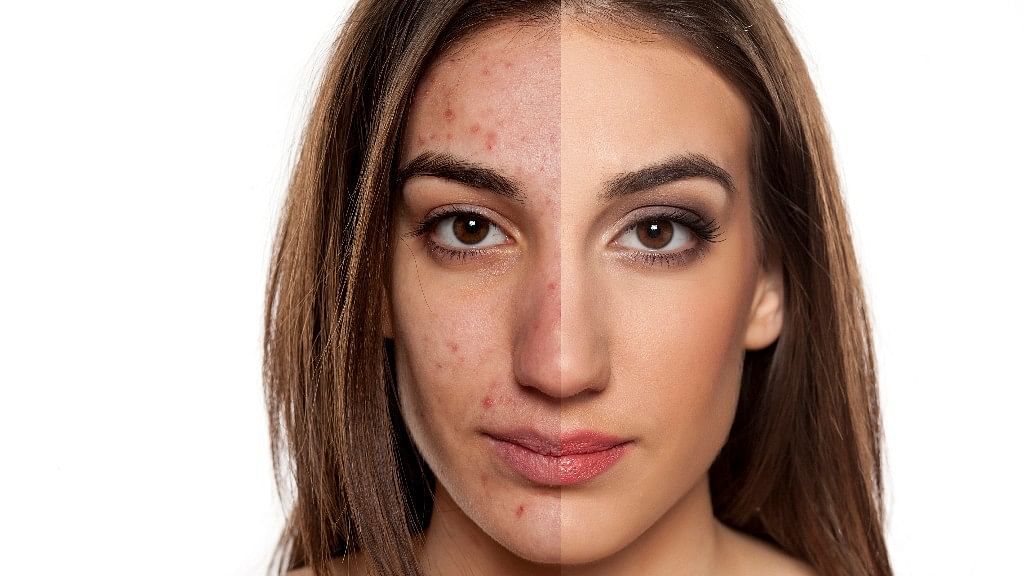 FitQuiz: How Do You Fight Acne - Yes to Besan, No to Stress?