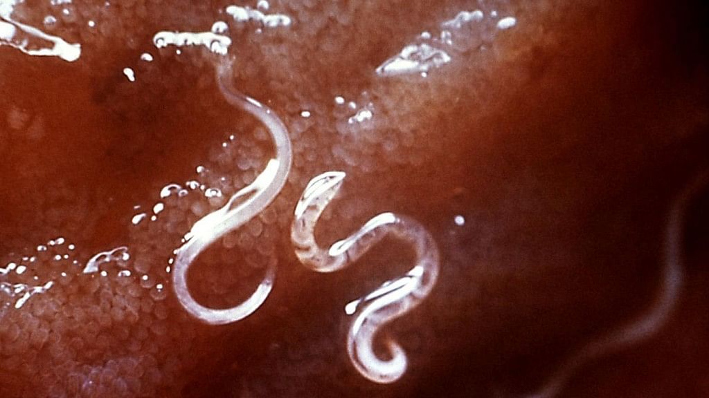 22 litres of blood was sucked by hookworms in the boy’s small intestine over the last two years.