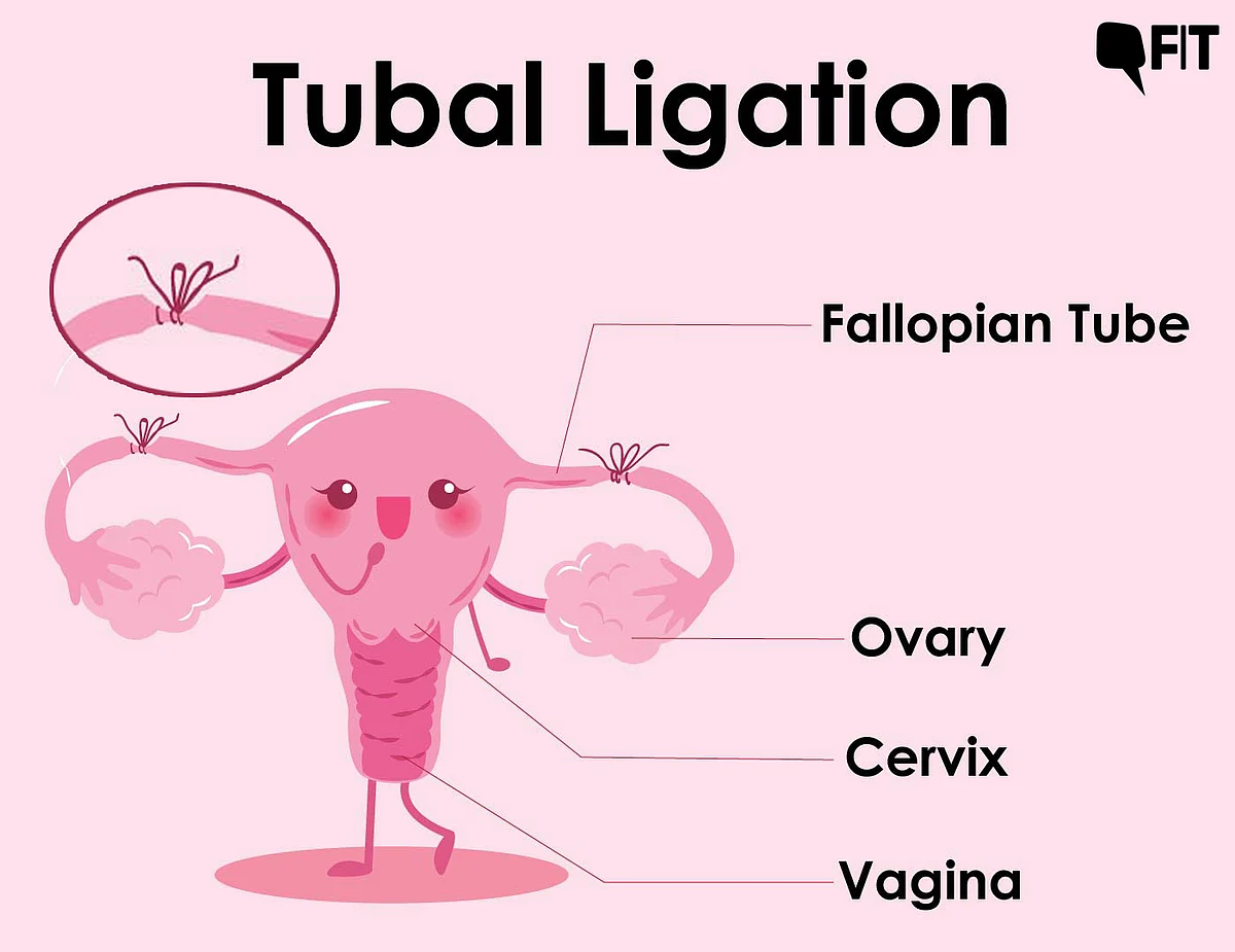 Clips are placed on fallopian tubes through a process called tubal ligation.