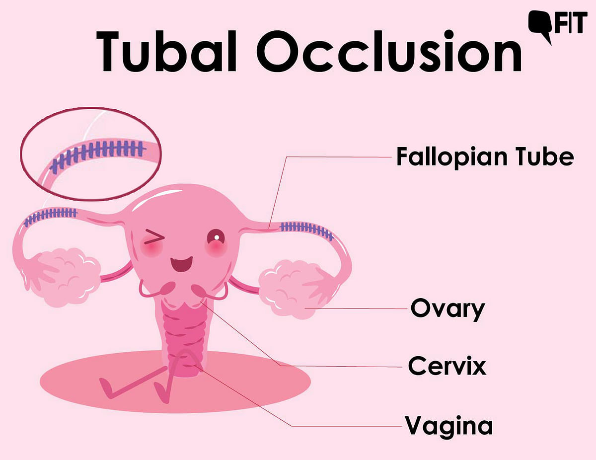 In tubal occlusion, little devices are placed inside fallopian tubes.