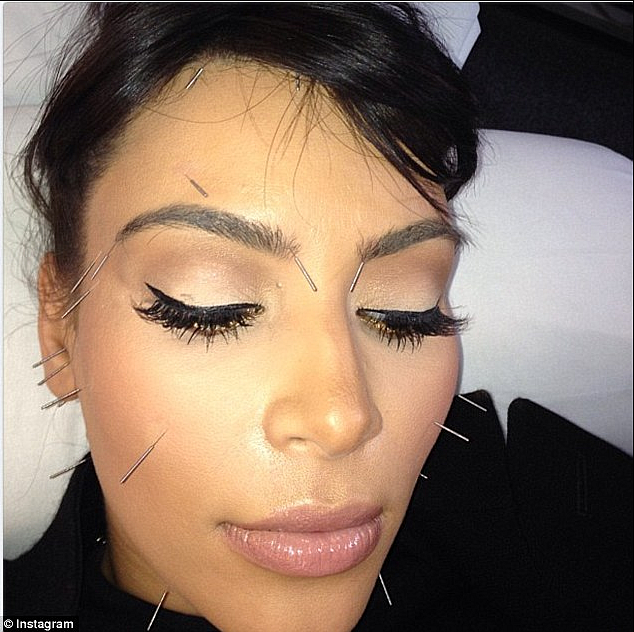 Reality TV star Kim Kardashian is a fan of cosmetic acupuncture.