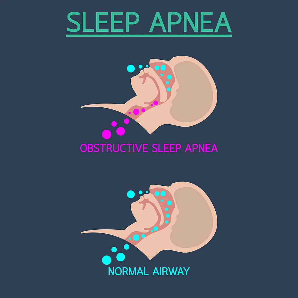 Snoring May Not Be as Harmless as You Think. Here’s How to Stop It