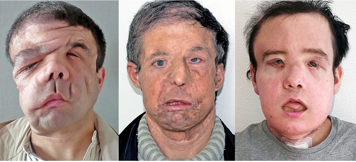 In January 2018, when a second face donor for Hamon became available, Lantieri and his team performed a second face transplant.