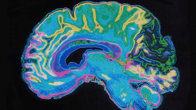 Brain scan of an Alzheimer’s patient.