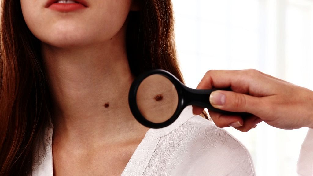 Let’s look some of the common questions about birthmarks and debunk some myths.&nbsp;