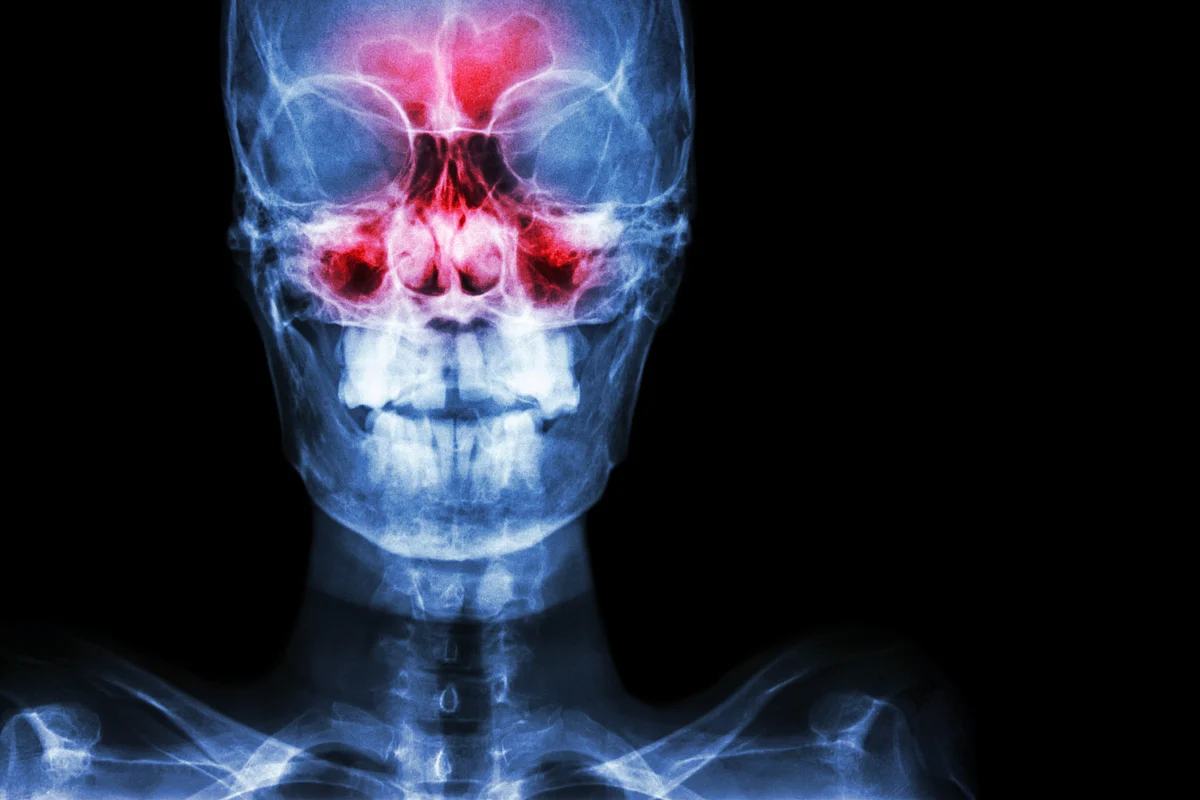 The condition is caused by anything that blocks the sinus openings in the nasal passage.