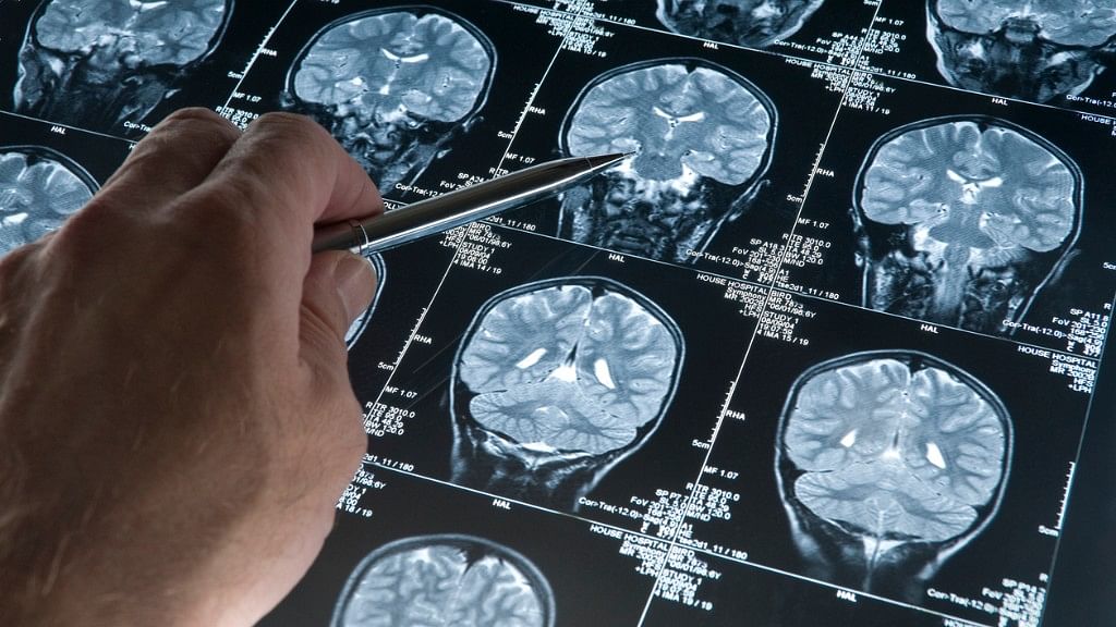 A new drug can potentially stop the spread of glioblastoma. 